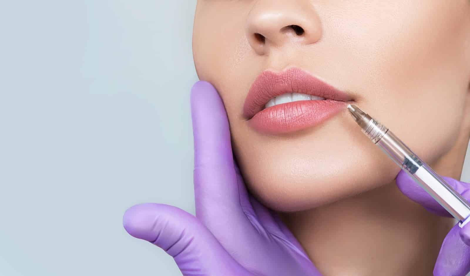 Procedure Showcasing Lip Corner Uplift With Filler