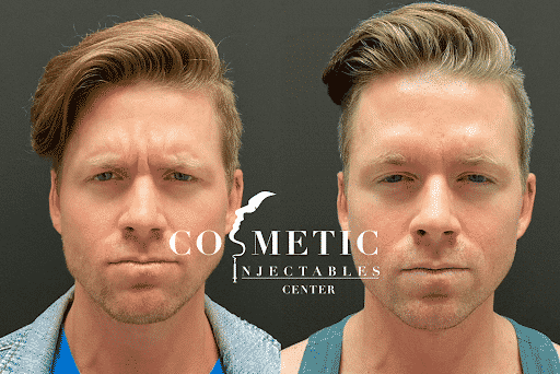 Male Botox Injectables - Professional Cosmetic Services In Sherman Oaks