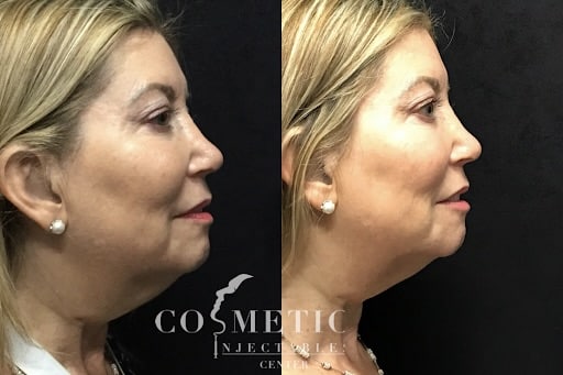 Kybella Before And After 2