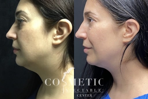 Kybella Before And After 3