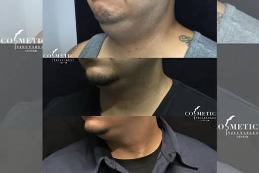 Kybella Before And After Man