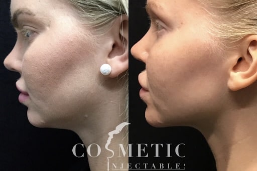 Kybella Before And After Women
