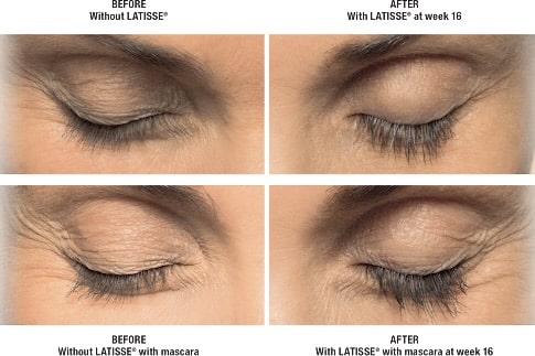 Latisse Before And After Eyes Closed