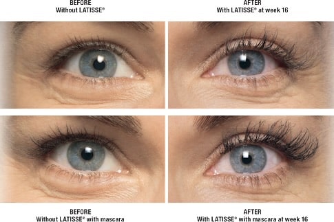 Latisse Before And After Eyes Open