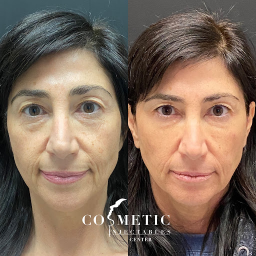 Restylane Lyft Face Before And After Sherman Oaks