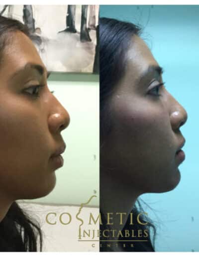 Chin2 579X579 1 | Cosmetic Injectables Center Medspa | Sherman Oaks, Los Angeles, Ca