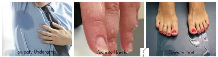 Hyperhidrosis Condition With Visible Sweat On Underarms, Hands, And Feet, Suitable For Injectable Treatments.
