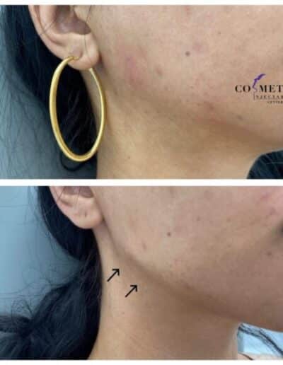 Jaw11 1024X1024 1 579X579 1 | Cosmetic Injectables Center Medspa | Sherman Oaks, Los Angeles, Ca