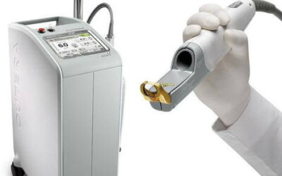 Cutera Excel V Laser Treatment Sherman Oaks