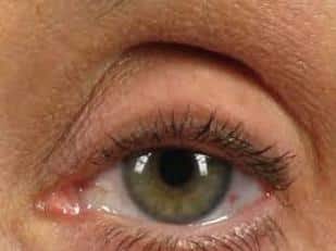 green eye brow sulcus hollowing | Cosmetic Injectables Center Medspa | Sherman Oaks, Los Angeles, CA