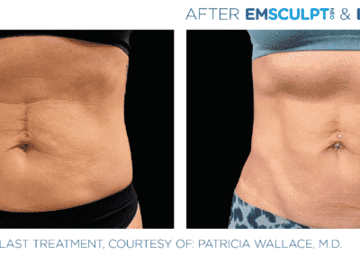 Emsculpt Neo Before &Amp; After