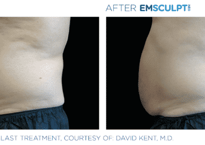 Emsculpt Neo Before &Amp; After