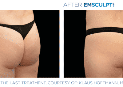 Emsculpt Neo Before &Amp; After