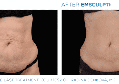 Emsculpt Neo Before &Amp; After