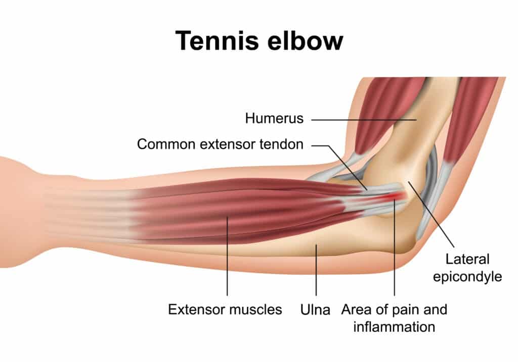 Botox For Tennis Elbow