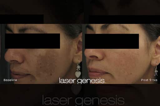 Laser For Pigmentation Before And After