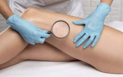 Asclera Vein Injections Sherman Oaks