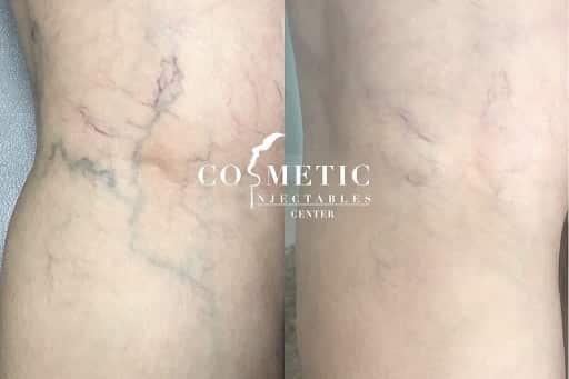 Asclera Vein Injections Before And After 1