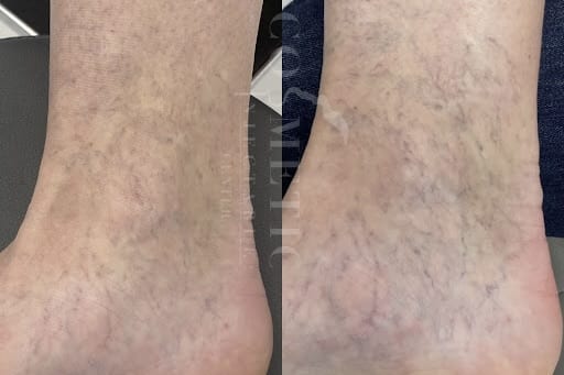 Asclera Vein Injections Before And After 2