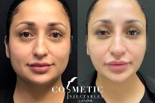 Botox For Tmj Before And After 1