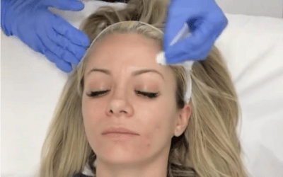 Monthly Chemical Peels: Are Regular Treatments Right for You?