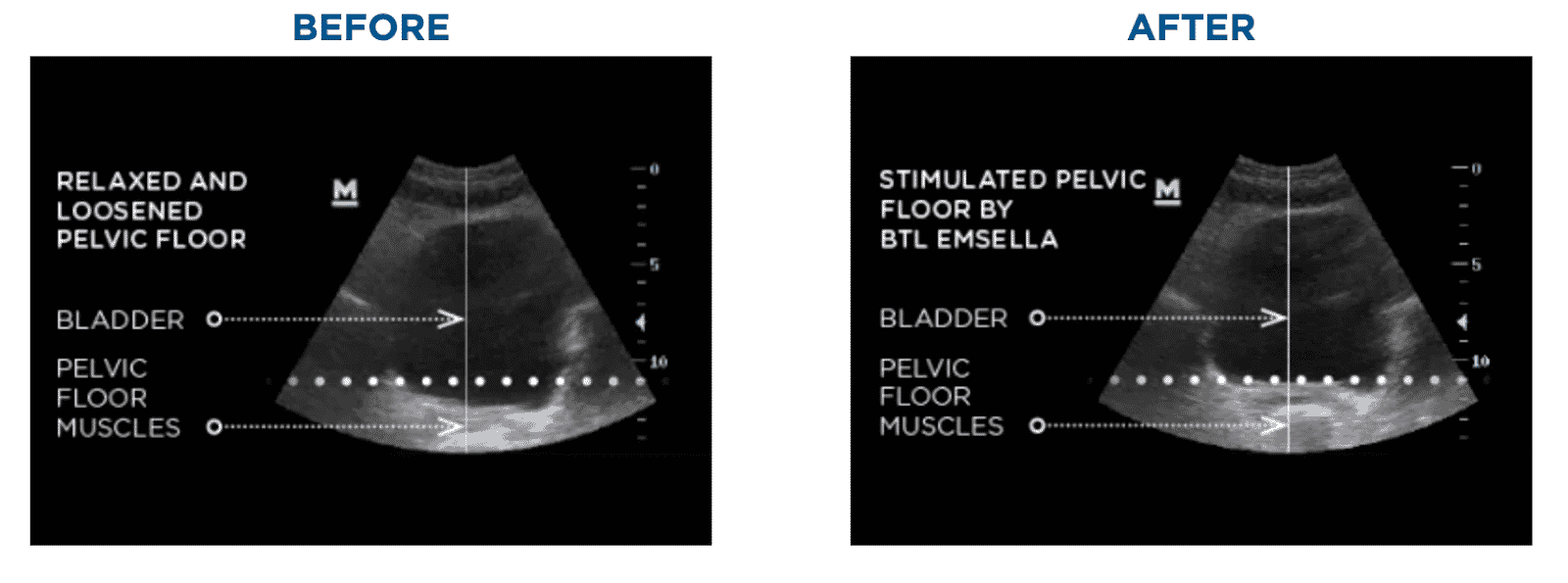 Emsella Pelvic Before And After Ultrasound