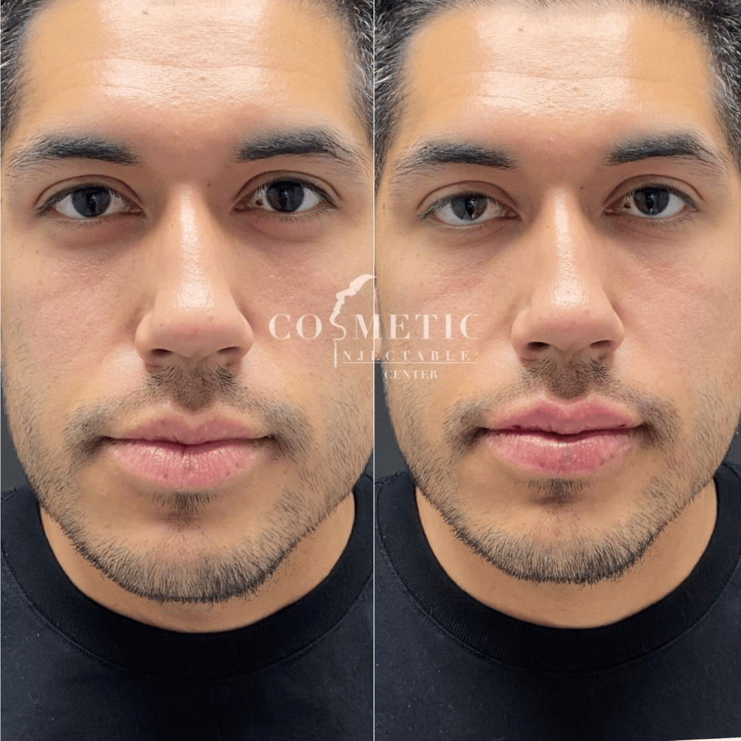 Lip Filler For Men Before And After