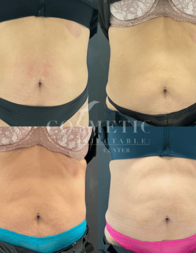 Emsculpt Neo Body Sculpting Midsection Before And After