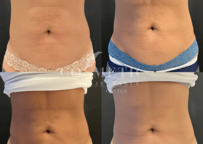 Emsculpt Neo Body Sculpting Results