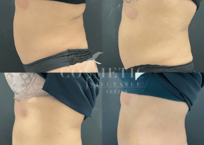 Emsculpt Neo Body Contouring Treatment Sherman Oaks