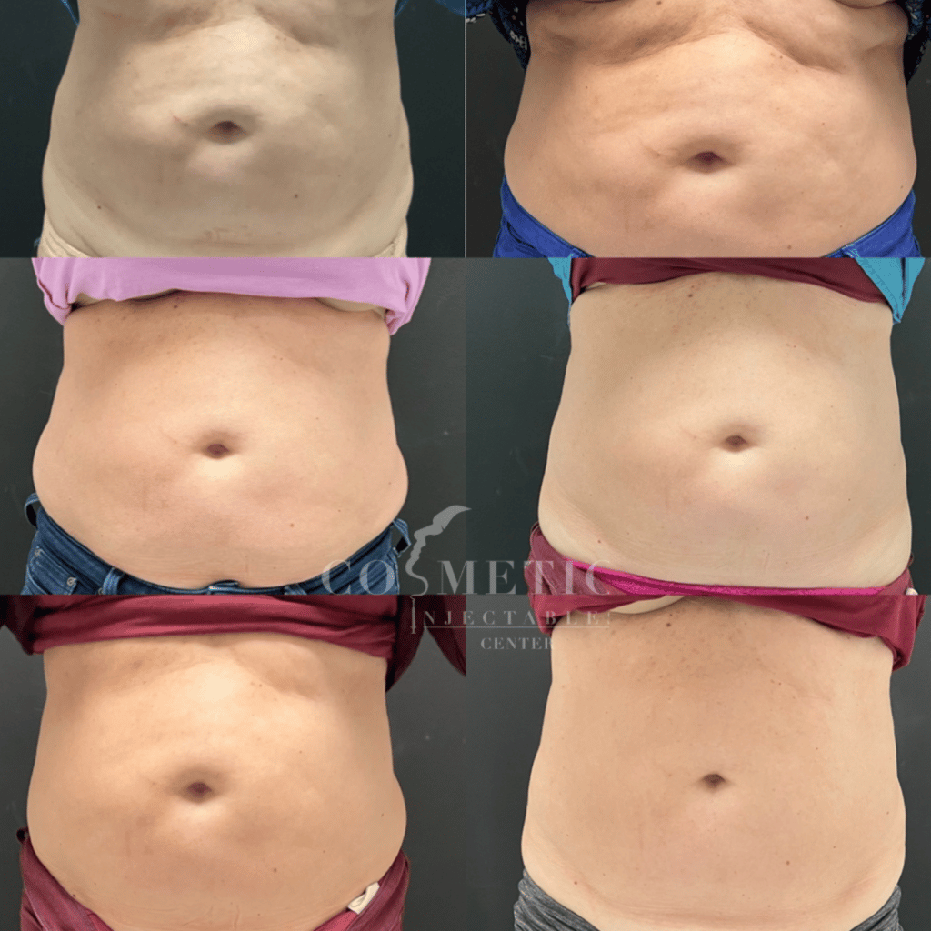EmSculpt Neo Body Sculpting Treatment Result Progression