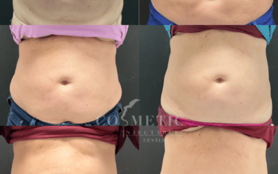 6 uses for botox—including some you may not have known! 6 How Emsculpt Neo Builds Muscle And Reduces Fat At The Same Time