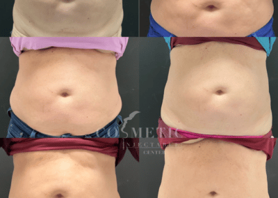 Emsculpt Neo Body Sculpting Treatment Result Progression