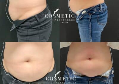Emsculpt Neo Body Contouring Before And After