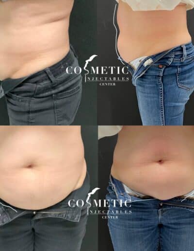 Emsculpt Neo Body Contouring Before And After