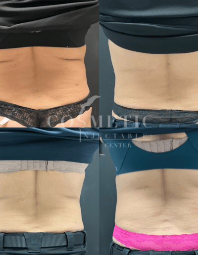 Emsculpt Neo Back Body Contouring Before And After