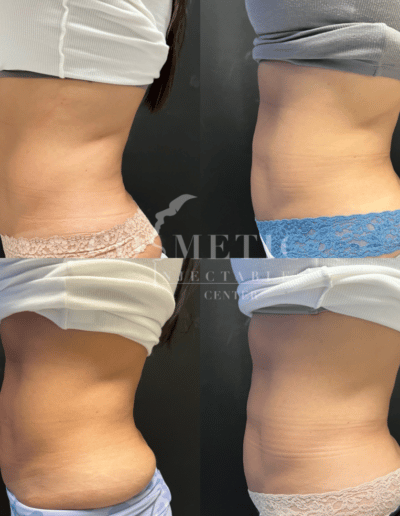 Emsculpt Neo Body Contouring Side Body Before And After