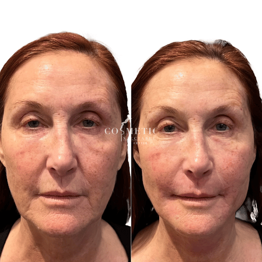 Pdo Barbed Thread Lift For A Youthful Appearance - Patient 2'S Transformation