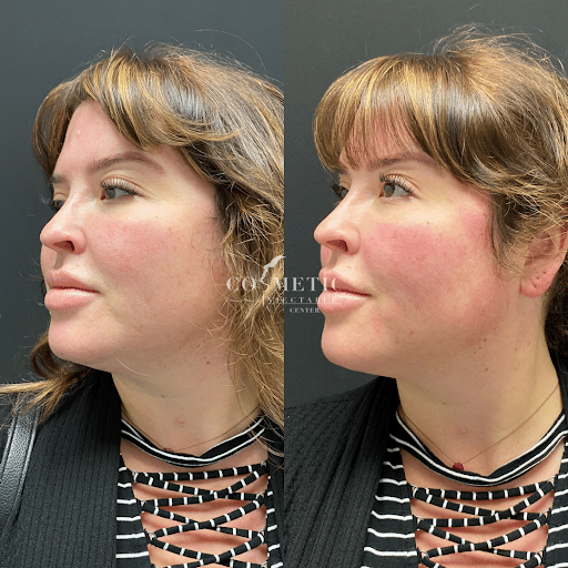 Barbed Pdo Threads For Non-Surgical Facelifts - Before And After Image Of Female Patient.