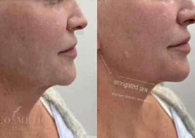 Juvederm Volux Sherman Oaks Before And After Elongated Jaw