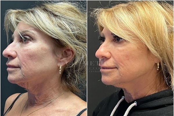 Juvederm Volux Sherman Oaks Before And After Female Patient