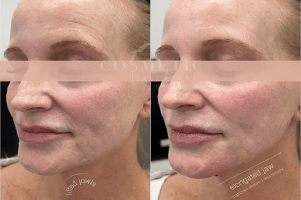 Juvederm Volux Sherman Oaks Before And After Lifted Jowls And Elongated Jaw