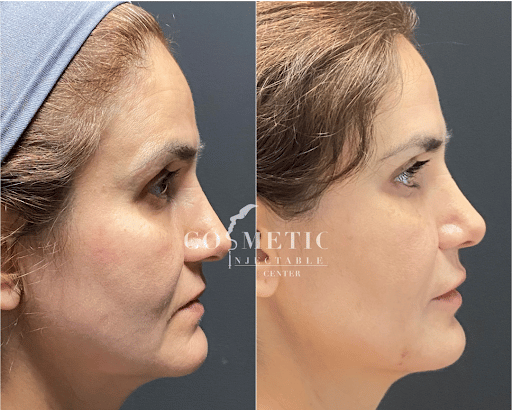Liquid Facelift Before And After To Female Patient Side View