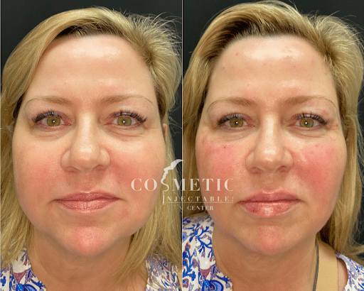 Liquid Facelift Before And After To Female Patient