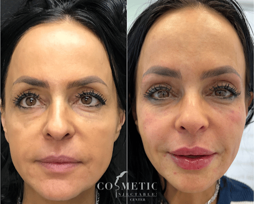 Before And After Liquid Facelift Procedure