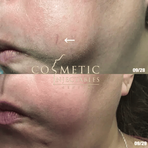 Skin Face Before And After Laser For Veins