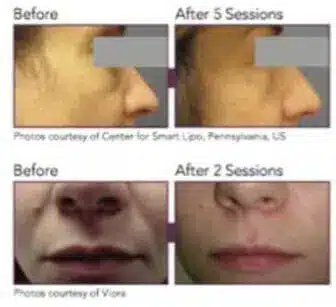 Transformed Skin Appearance With Radio Frequency Skin Tightening - Before And After Patient 2