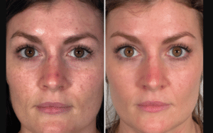 Morpheus8 Before And After To Female Patient Hyperpigmentation