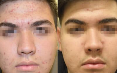 Acne Treatment Options Offered at Medical Spas: What Patients Should Know