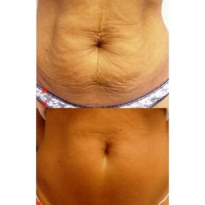 Morpheus8 Before And After To Tummy Of Patient